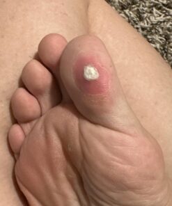 Compound W Maximum Strength Fast Acting Liquid Wart Remover, 0.31 fl oz 37 717ccL3j4UL