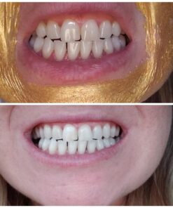 Dental Hygiene Kit - Calculus & Plaque Remover Dental Tool Set - Stainless Steel Tarter Scraper, Tooth Pick, and Mouth Mirror - Dentist Instrument Set for Teeth Cleaning (Blue) Blue 46 718weoDkTgL