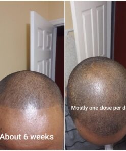 6 Months Kirkland Minoxidil 5% Extra Strength Hair Loss Regrowth Treatment Men, 12 Fl Oz (Pack of 6) 46 71AWlbp9oL