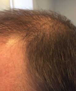 Hairgenics Pronexa Clinical Strength Hair Growth & Regrowth Therapy Hair Loss Shampoo With Biotin, Collagen, and DHT Blockers for Thinning Hair, 8 fl. oz. 56 71CVocgNyEL