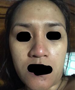 Silk’N Revit - Blackhead Remover Vacuum - Microdermabrasion Machine - Cleansing Exfoliating Face Scrub Pore Vacuum 51 71CeKvdHroL 1