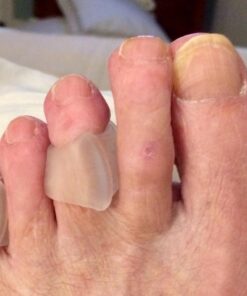 Natracure Advanced Gel Toe Separator (w/Toe Loop) - Spacer, Corrector, Straightener to Cushion and Align Bent, Crooked, Overlapping Toes - Corns, Pinky Tailor Bunions - (1104-M CAT 2PK) - Size: Small Small (Pack of 2) 17 71EB45lMB1L