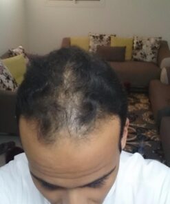 WICK & STRÖM Hair Loss Vitamins - 2 Month Supply - DHT Blocker Support- With Saw Palmetto Hair Growth Support Rich in Biotin - (Wick & Strom Hair Loss Products for Men and Women) 36 71Eu75KzxUL