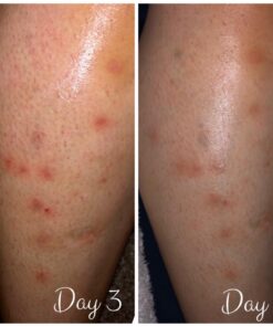 Cammile Q Organic Tamanu Oil - Natural Psoriasis Treatment - Great For Eczema, Acne & Scars - Cold Pressed 36 71F9YLyfBOL