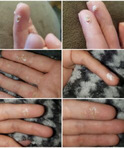 Compound W Maximum Strength Fast Acting Gel Wart Remover, 0.25 oz, 2 Pack unflavored 0.5 Ounce (Pack of 1) 49 71H6V3XuSVL