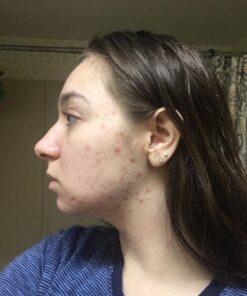 Organic Rosehip Oil – 100% Pure Unrefined Cold Pressed Rosehip Seed Oil - Best Moisturizer for Face, Hair - Great for Fine Lines, Wrinkles, Acne Scars, Sun Damage, Stretch Marks, Eczema, Psoriasis 4 Fl Oz (Pack of 1) 35 71Hs749Y8nL