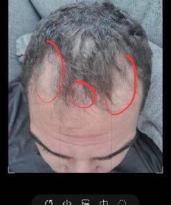 iRestore Essential Laser Hair Growth System - FDA Cleared Hair Loss Treatments for Men & Women & Hair Growth Products for Men with Thinning Hair, Hair Regrowth Treatments Laser Cap, Red Light Therapy 48 71IKh6B5pDL 1