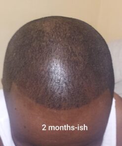 6 Months Kirkland Minoxidil 5% Extra Strength Hair Loss Regrowth Treatment Men, 12 Fl Oz (Pack of 6) 47 71IkxjDTeKL