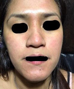 Silk’N Revit - Blackhead Remover Vacuum - Microdermabrasion Machine - Cleansing Exfoliating Face Scrub Pore Vacuum 53 71JOyZj8otL 1