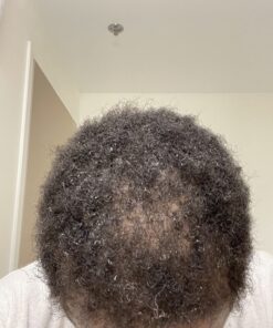 6 Months Kirkland Minoxidil 5% Extra Strength Hair Loss Regrowth Treatment Men, 12 Fl Oz (Pack of 6) 56 71KDEUQ34fL