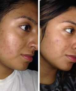 InstaNatural BHA Exfoliating Face Serum, Minimizes Lines, Wrinkles, and Blemishes, with Vitamin C and Salicylic Acid, 1 Fl Oz 39 71KYF3xbu0L