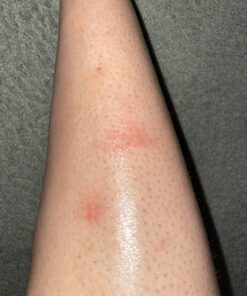 Dermoplast Pain, Burn & Itch Relief Spray for Minor Cuts, Burns and Bug Bites, 2.75 Oz (Packaging May Vary) Relief Spray (1 Pack) 46 71KzilA5MWL 2