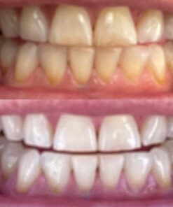 Auraglow 35% Teeth Whitening Gel Syringe Refill Pack, 35% Carbamide Peroxide, 30 Whitening Treatments, (3) 5mL Whitening Gel Syringes, Sensitive Teeth Whitening 31 71LViWRg5sL