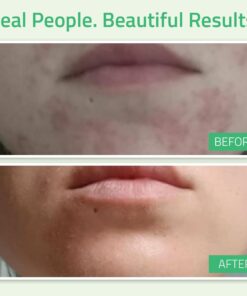 YEOUTH Glycolic Acid Peel for Face Professional 30% Gel with Retinol & Green Tea, Chemical Peel for Face at Home for Wrinkles, Dark Spots & Acne, Skin Care Chemical Exfoliant, Glycolic Acid Serum Glycolic 30% Peel 1oz 25 71Lcsxp8 8L