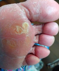 Emjoi Micro-Pedi 3D POWER Callus Remover with Xtreme Coarse Soft & Flexible Roller (Most Powerful & Corded) Blue 1 Count (Pack of 1) 22 71M5Kk0VeAL