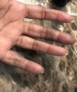 Cammile Q Organic Tamanu Oil - Natural Psoriasis Treatment - Great For Eczema, Acne & Scars - Cold Pressed 43 71OsL3JEeL