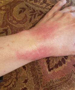 Ethically Sourced Emu Oil for Chemo & Radiation Burns LS Piercing Aftercare Tattoo After Care Face & Body Moisturizer TSW Red Skin Syndrome Lichen Sclerosus Relief 100% Pure AEA Certified 15 71R864pbTXL