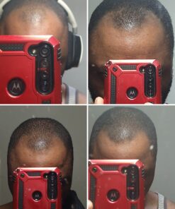 6 Months Kirkland Minoxidil 5% Extra Strength Hair Loss Regrowth Treatment Men, 12 Fl Oz (Pack of 6) 53 71ROzQ2ujkL