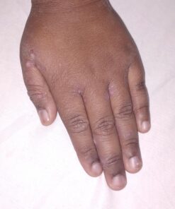 SkinSmart Antimicrobial Eczema Therapy with Hypochlorous Acid, Removes Bacteria so Skin Can Heal, for Adults, Kids and Seniors, 8 Ounce Clear Spray 8 Fl Oz (Pack of 1) 35 71S1z92R 0L