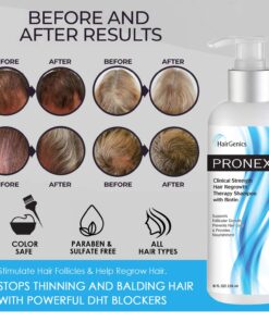 Hairgenics Pronexa Clinical Strength Hair Growth & Regrowth Therapy Hair Loss Shampoo With Biotin, Collagen, and DHT Blockers for Thinning Hair, 8 fl. oz. 33 71W8 aWPsmL