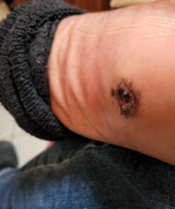 Dr. Nordyke's Wound Honey New Zealand Manuka Honey for Infections,Burns,Cuts and Scars (80g) 2.8 Ounce (Pack of 1) 20 71ZADrZYG8L