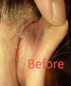 TEA TREE OIL BALM -100% All Natural | Great Cream for Soothing Irritations like Eczema, Psoriasis, Rashes, Insect Bites, Folliculitis, Acne, Itches, Dry Chapped Heels, Cuticles, Saddle Sores and more! 46 71buY3pU8QL