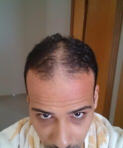 WICK & STRÖM Hair Loss Vitamins - 2 Month Supply - DHT Blocker Support- With Saw Palmetto Hair Growth Support Rich in Biotin - (Wick & Strom Hair Loss Products for Men and Women) 38 71c0oDVfcZL