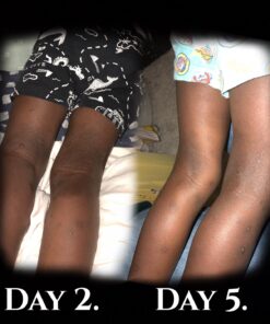 Cammile Q Organic Tamanu Oil - Natural Psoriasis Treatment - Great For Eczema, Acne & Scars - Cold Pressed 50 71chHSq3MSL