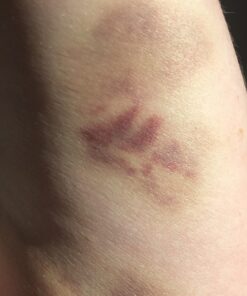 Cammile Q Organic Tamanu Oil - Natural Psoriasis Treatment - Great For Eczema, Acne & Scars - Cold Pressed 49 71d3pyF91rL