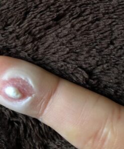 Compound W Nitrofreeze | Wart Removal | 1 Pen & 5 Replaceable Tips 47 71dM1vjiWzL