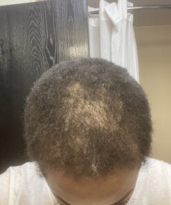 6 Months Kirkland Minoxidil 5% Extra Strength Hair Loss Regrowth Treatment Men, 12 Fl Oz (Pack of 6) 57 71etJUtCq9L