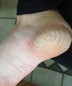 Emjoi Micro-Pedi 3D POWER Callus Remover with Xtreme Coarse Soft & Flexible Roller (Most Powerful & Corded) Blue 1 Count (Pack of 1) 19 71fR3GYbNsL