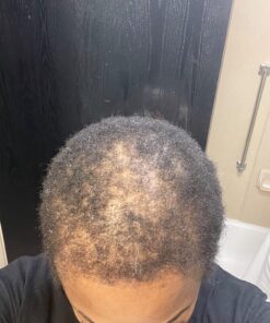 6 Months Kirkland Minoxidil 5% Extra Strength Hair Loss Regrowth Treatment Men, 12 Fl Oz (Pack of 6) 58 71ficVLW4LL