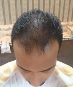 WICK & STRÖM Hair Loss Vitamins - 2 Month Supply - DHT Blocker Support- With Saw Palmetto Hair Growth Support Rich in Biotin - (Wick & Strom Hair Loss Products for Men and Women) 40 71glRuWre3L