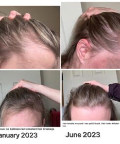 iRestore Essential Laser Hair Growth System - FDA Cleared Hair Loss Treatments for Men & Women & Hair Growth Products for Men with Thinning Hair, Hair Regrowth Treatments Laser Cap, Red Light Therapy 42 71gnIFTrmsL 1