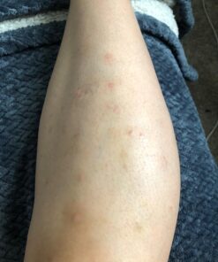 Cammile Q Organic Tamanu Oil - Natural Psoriasis Treatment - Great For Eczema, Acne & Scars - Cold Pressed 37 71gzRvb5LmL