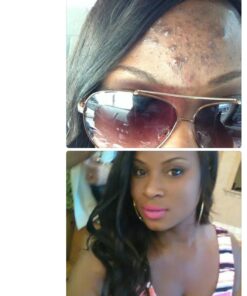 Estroblock PRO Triple Strength - 60 Capsules, DIM & Indole 3-Carbinol for Natural Hormonal Hormone Balance, Acne - Anti Toxic Estrogen Aromatase Inhibitor Blocker. Soy Free, Dairy Free, Non-GMO (1) 1 79 71hQe2fyKnL 2