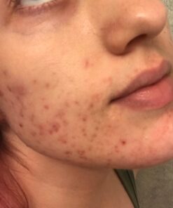 Acnetame Acne Pills- Vitamin Supplements for Acne Treatment- Natural Clear Skin from Hormonal Cystic Pimples- Oily Skin Vitamins Pill for Women, Teen, Men, & Adults 60 Tablets 60 Count (Pack of 1) 44 71iHoWiGjaL 1