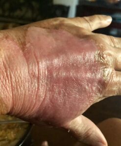 Silver Miracles Colloidal Silver Gel - Nano Silver Gel Wound Care - Healing Ointment for Burns, Sunburns & Irritated Skin - 4 Oz Unscented 48 71jok97WRRL