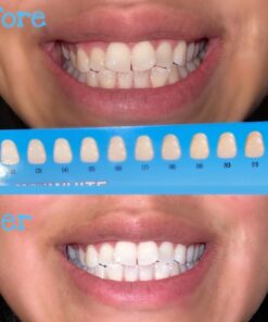 Dental Duty Sensitive Teeth Whitening Strips – Professional Vegan Stain Remover White Strips for Sensitive Teeth for Coffee & Tea Stains – Get A Lighter Shade After One Application – 28 Strips 43 71kLfm4hBiL