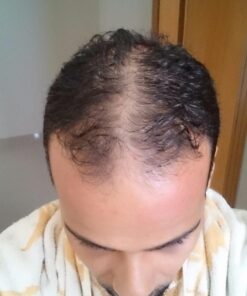 WICK & STRÖM Hair Loss Vitamins - 2 Month Supply - DHT Blocker Support- With Saw Palmetto Hair Growth Support Rich in Biotin - (Wick & Strom Hair Loss Products for Men and Women) 43 71l6MFGVqJL 1