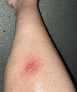 Dermoplast Pain, Burn & Itch Relief Spray for Minor Cuts, Burns and Bug Bites, 2.75 Oz (Packaging May Vary) Relief Spray (1 Pack) 47 71l9y2q8G L 1