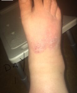 TEA TREE OIL BALM -100% All Natural | Great Cream for Soothing Irritations like Eczema, Psoriasis, Rashes, Insect Bites, Folliculitis, Acne, Itches, Dry Chapped Heels, Cuticles, Saddle Sores and more! 38 71loJKY9 eL