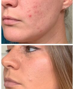 Acnetame Acne Pills- Vitamin Supplements for Acne Treatment- Natural Clear Skin from Hormonal Cystic Pimples- Oily Skin Vitamins Pill for Women, Teen, Men, & Adults 60 Tablets 60 Count (Pack of 1) 54 71mOTCqQnML 1