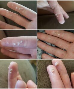 Compound W Maximum Strength Fast Acting Gel Wart Remover, 0.25 oz, 2 Pack unflavored 0.5 Ounce (Pack of 1) 51 71oE1fXmPHL