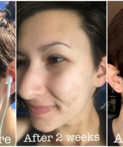 InstaNatural BHA Exfoliating Face Serum, Minimizes Lines, Wrinkles, and Blemishes, with Vitamin C and Salicylic Acid, 1 Fl Oz 36 71oqV6rwIAL