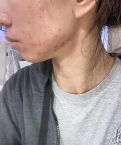 SALICYLIC Acid Peel 30% Chemical Peel with Beta Hydroxy BHA For Rosacea, Acne, Oily Skin, Blackheads, Whiteheads (1 oz / 30ml) 19 71p7WxiXpTL