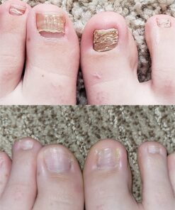 Kerasal Nail Renewal, Restores Appearance of Discolored or Damaged Nails, 0.33 fl oz (Packaging May Vary) 40 71qTRKzY7wL