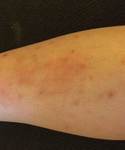 Antibacterial Skin Repair Max 3X Natural Ingredients - For Fissures Folliculitis Angular Cheilitis Impetigo Chilblains Lichen Sclerosus Cellulitis (14gm tube) 0.49 Ounce (Pack of 1) 22 71tNnSLJK7L