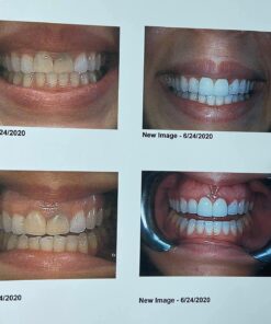 Dental Duty Sensitive Teeth Whitening Strips – Professional Vegan Stain Remover White Strips for Sensitive Teeth for Coffee & Tea Stains – Get A Lighter Shade After One Application – 28 Strips 35 71uR238MlsL